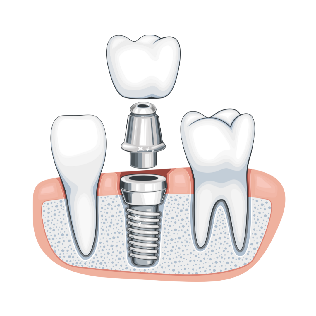 Single Tooth Implants  in Houston, TX