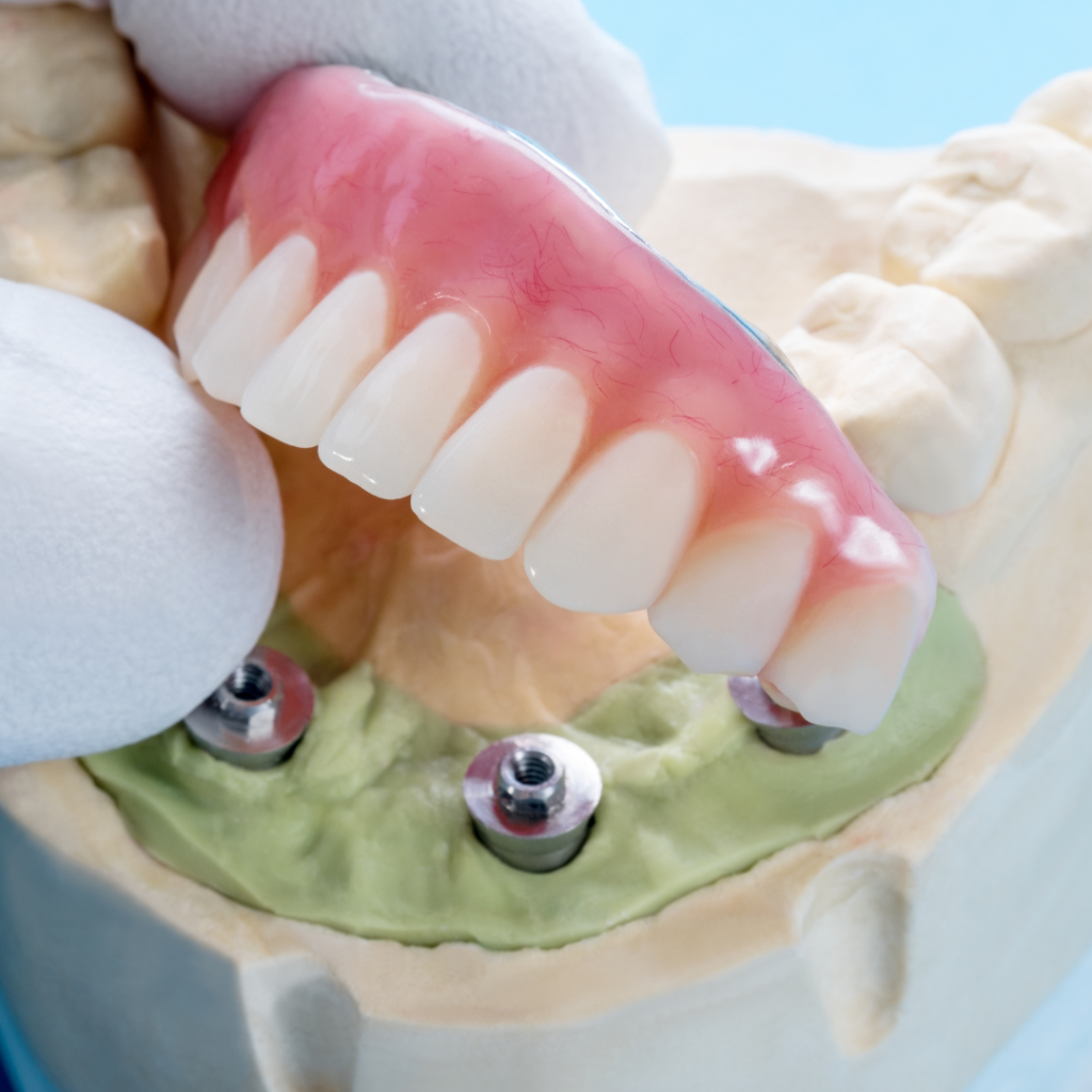 Dental Implants Houston TX